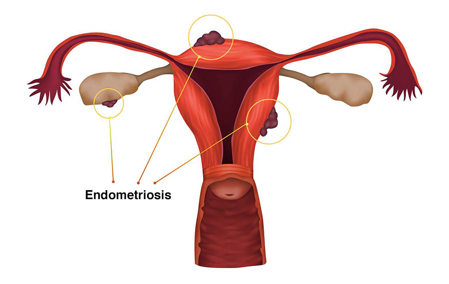 Endometriosis Treatment in Indirapuram,Ghaziabad
