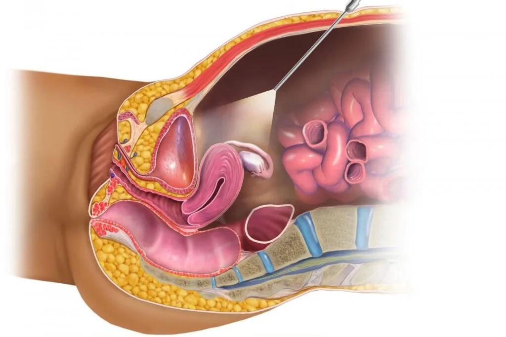 Fertility-Enhancing Laparoscopic Surgery