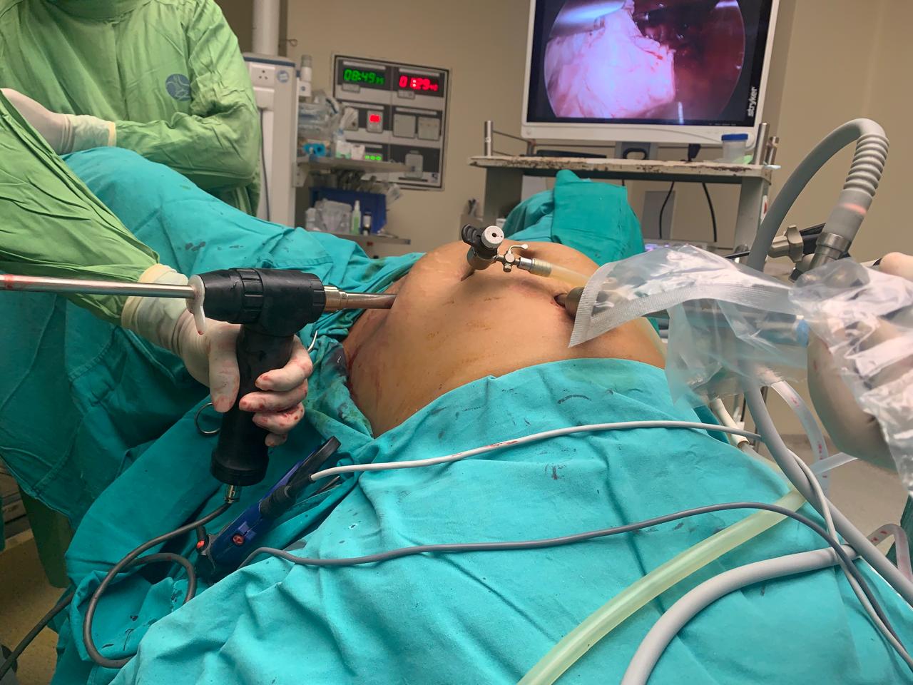 Fibroid Treatment in Indirapuram