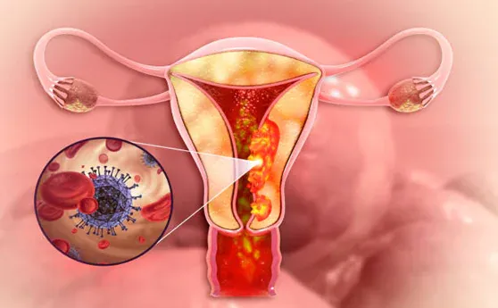 Hysterectomy Treatment in Indirapuram,Ghaziabad