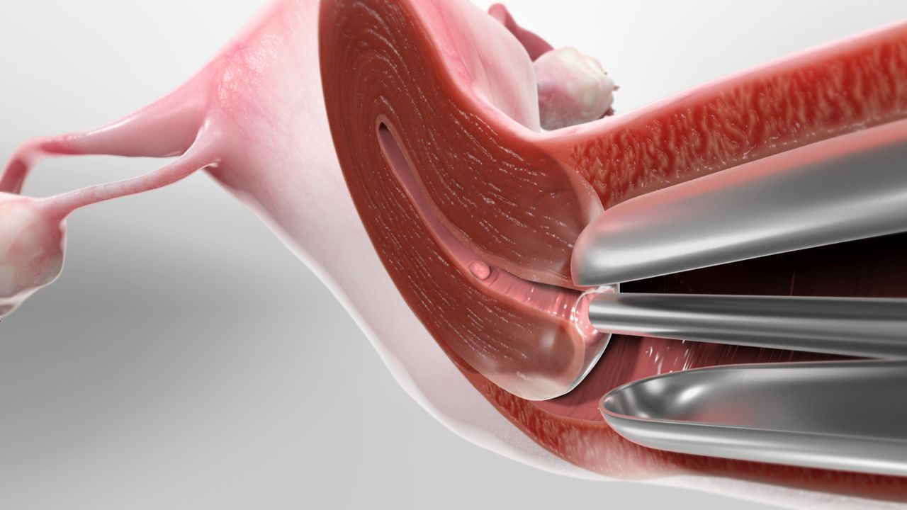 Hysteroscopy Procedure Treatment in Indirapuram,Ghaziabad