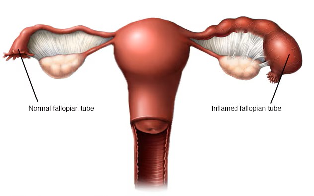 Pelvic Infections Treatment�in�Indirapuram